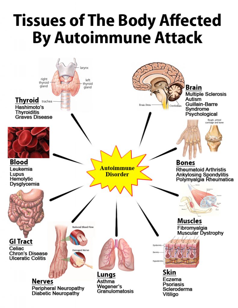 What Autoimmune Disease Attacks Muscles